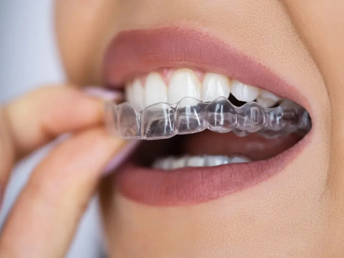 Aparelho fixo ou alinhador invisível? Entenda as diferenças e descubra o melhor para você